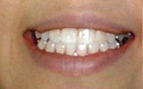 teeth whitening after